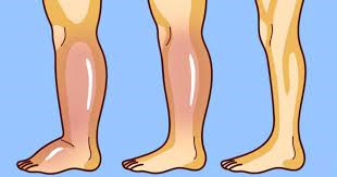  4 ways to reduce fluid retention in the body